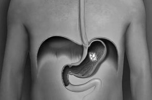 How-do-you-reduce-acid-through-low-acid-coffee How do you reduce acid through low acid coffee